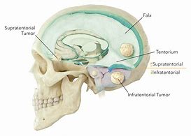 Image result for Human Brain Tumor