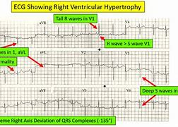 Image result for Right Ventricular Hypertrophy