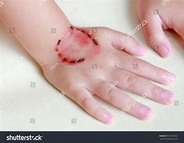 Image result for Human Bite Bruse