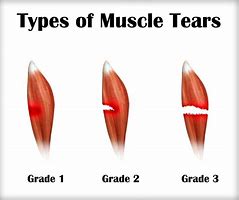 Image result for Micro Tears in Muscle Fiber Under Microscopes