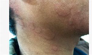 Image result for Red Line On Neck From Necklace