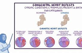 Image result for Cyanotic Heart Defect