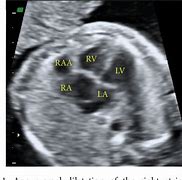 Image result for Right Atrial Appendage Fetal Echo