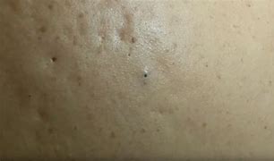 Image result for Pimple Black Spot