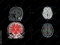 Image result for Coronal Plane Brain MRI