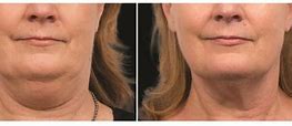 Image result for CoolSculpting Chin Before and After