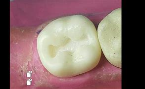 Image result for Mandibular 2nd Pre Molar