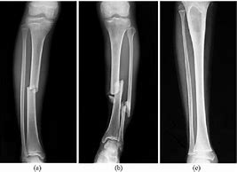 Image result for X-ray of Leg with Metal Plates