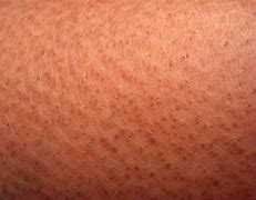 Image result for Dark Pigmentation On Legs