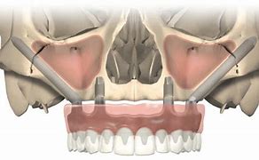 Image result for Zygomatic and Pterygoid Implants