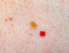 Image result for Small Red Circular Rash On Skin