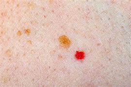 Image result for Red Flat Skin Lesion