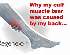 Image result for Tear in Calf Muscle