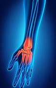 Image result for Wrist Injury