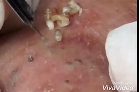 Image result for Pimple Popping