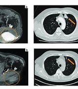 Image result for Sclerosis Bone Metastases X-ray