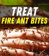 Image result for Ointment for Fire Ant Bites