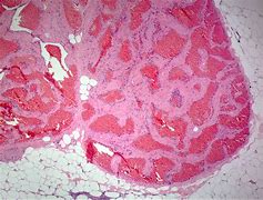 Image result for Hemangioma Tumor