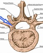 Image result for Pars Defect Lumbar Spine