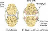 Image result for Hip Joint Space Narrowing