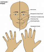 Image result for Gigantism Face