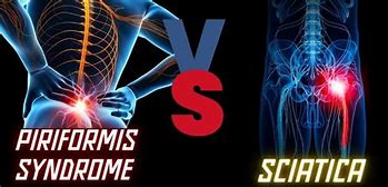 Image result for Piriformis Sciatica