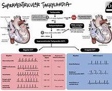 Image result for SVT Cardiology