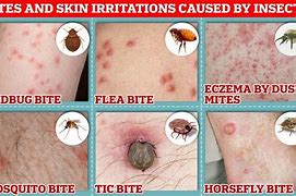 Image result for Baby Bed Bug Bites