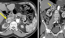 Image result for Pheochromocytoma CT Abdomen