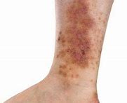 Image result for Dark Age Spots On Legs