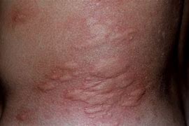 Image result for Benedryl Bug Bites