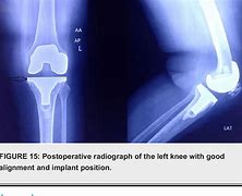 Image result for Ochronosis Knee