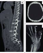 Image result for Sclerosis Bone Metastases X-ray