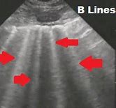 Image result for B Lines Chest Ultrasound