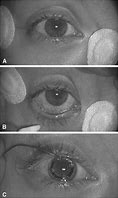 Image result for Erg Eye Dtl