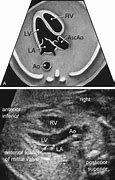 Image result for Rvot and LVOT Fetal Ultrasound Images Colour