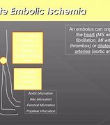 Image result for Acral Ischemia