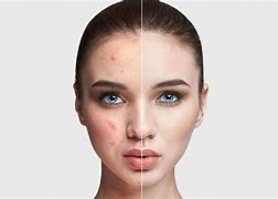 Image result for Subclinical Acne