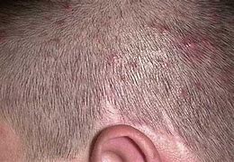 Image result for Bacterial Folliculitis Scalp