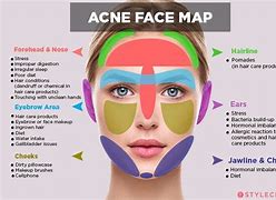 Image result for Acne Boy Face Map