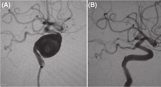 Image result for ICA Aneurysm