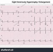 Image result for Right Ventricular Hypertrophy Echo