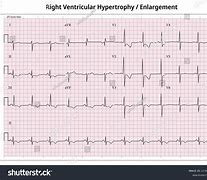 Image result for RVH ECG