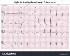 Image result for Right Ventricular Hypertrophy