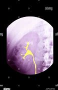 Image result for Kidney On X-ray