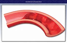 Image result for Vertebral Dissection On Angiogram