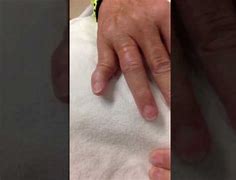 Image result for Dislocated Pinky Finger