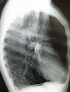 Image result for Emphysema