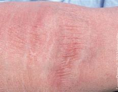 Image result for Clobetasol and Skin Atrophy