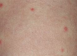 Image result for Circular Rash On Skin